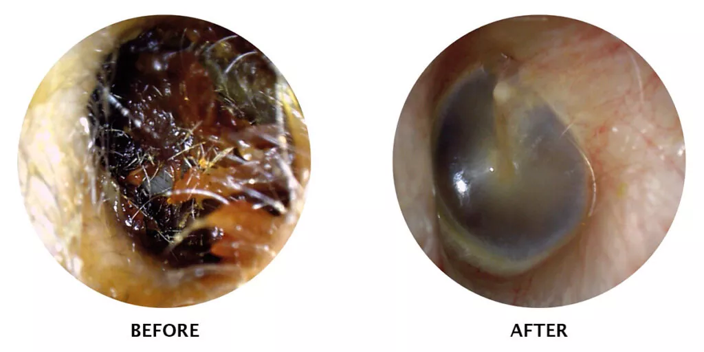 Ear Wax Removal Before and After