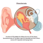 otosclerosis medical condition of the middle ear bones inside 277904 20187 1